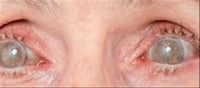 Diabetes Eye Problems: Diabetic Patients, Be Alert! How Diabetes Affects Your Eyes